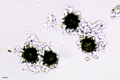 scleroderma-citrinum9