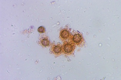 scleroderma-verrucosum10