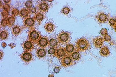scleroderma-verrucosum11