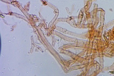 scleroderma-verrucosum12