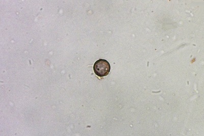 scleroderma-verrucosum9